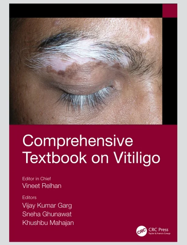 Comprehensive Textbook on Vitiligo
